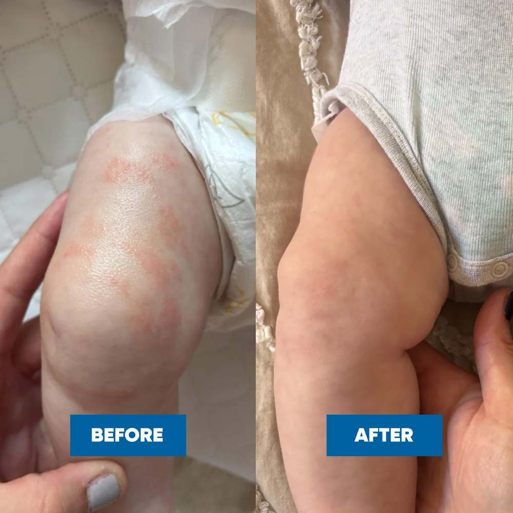 MooGoo Pink Eczema Cream Before and After