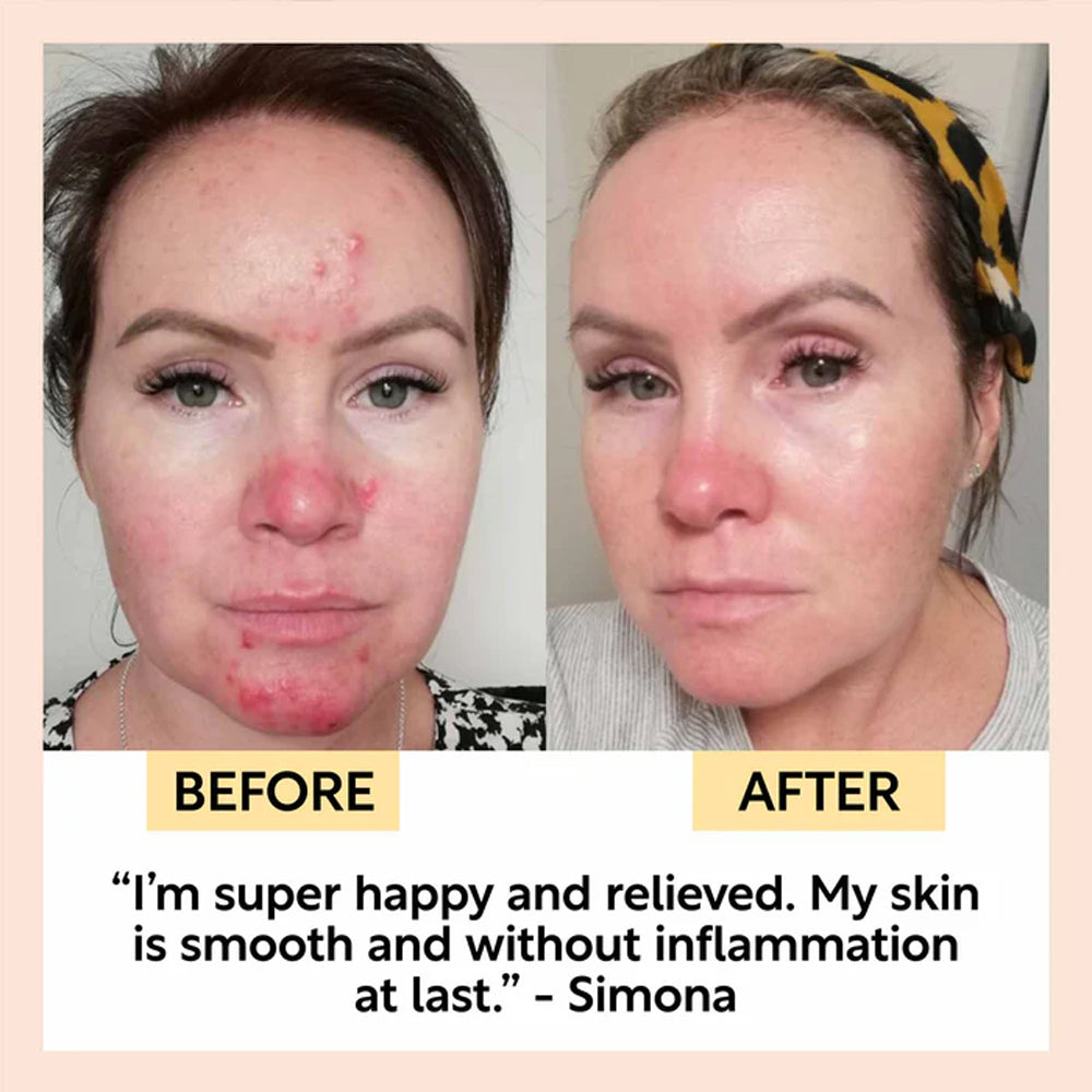Before and after comparison of a woman&